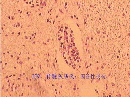 脊髓解剖及病理切片ppt