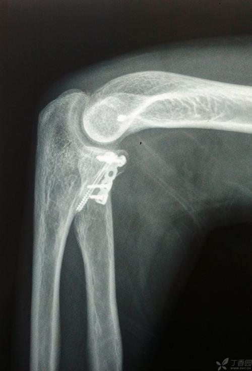 桡骨近端骨折治疗技巧
