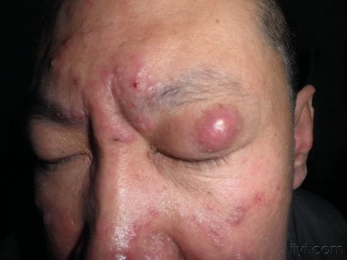 本型损害为深在性,无痛性脓肿,疖,或囊肿性结节