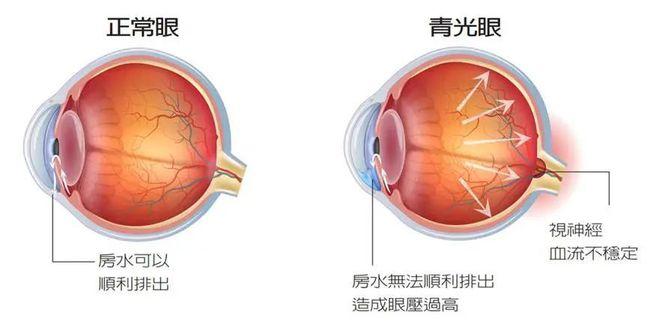 一,什么是青光眼?