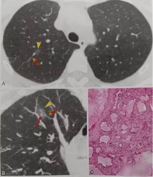 早期肺癌早发现——胸部ct筛查与诊断的重要性