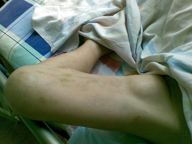 内科病人大腿根部肿块(附图片)性质待查