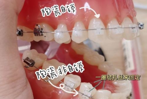 超级干货!所有牙套种类的优缺点分析,价格对比
