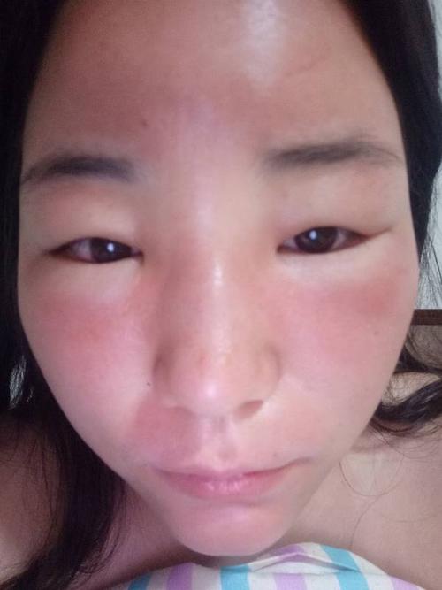 前天去水上乐园玩,皮肤被晒伤,主要是脸部.晒伤当天皮肤发红,第二