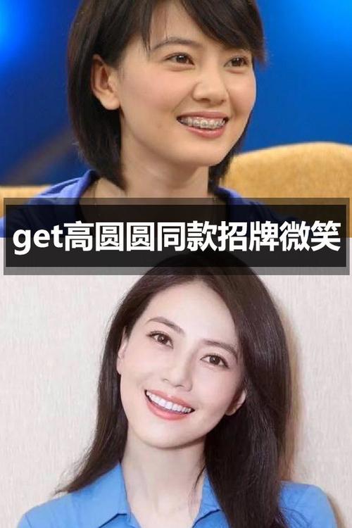 牙齿矫正|get高圆圆同款招牌微笑