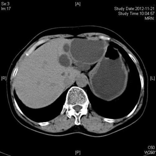要求给予治疗,从ct检查来看,肝内多发囊肿,最大者左右肝各一12cm直径