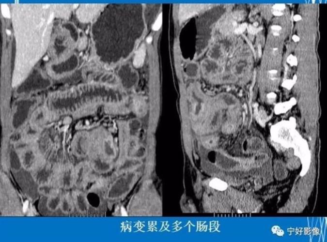 克罗恩病(crohn"sdiseasecd)的影像(副本)