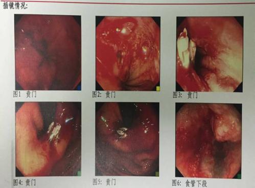 5℃;hr 178次/分;r 26次/分;bp 115/63mmhg;bd 65kg 胃镜检查结果