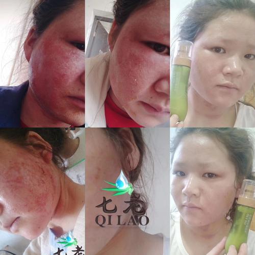 激素脸为什么会瘙痒夜间如何护理怎么修复