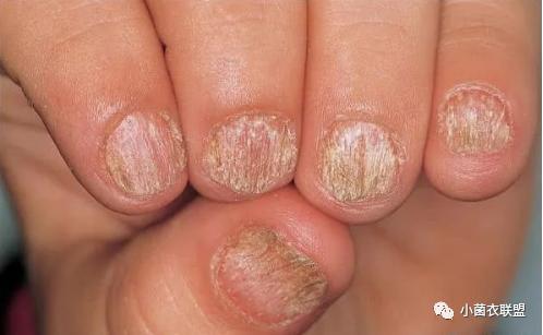 ③特里甲,表现为近端80%指甲是白色,而远端是正常的粉色.