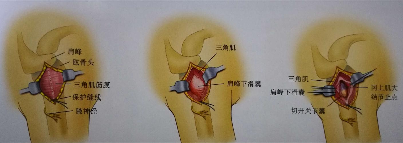 肱骨大结节骨折的治疗