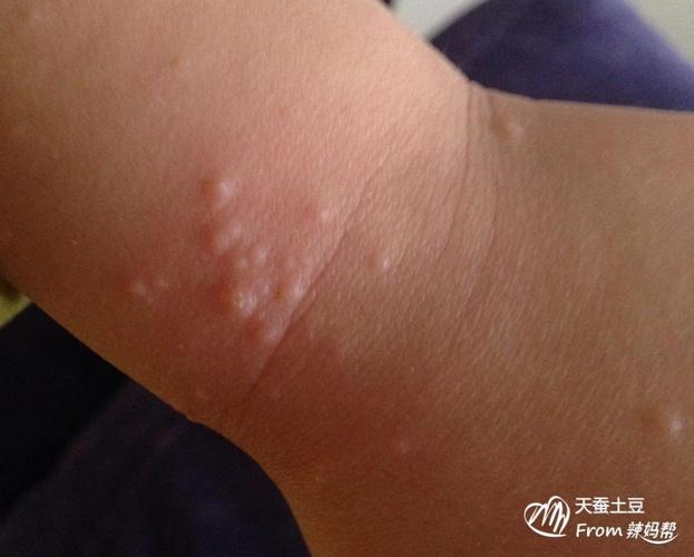   是沙土皮炎,我们正好周末去医院