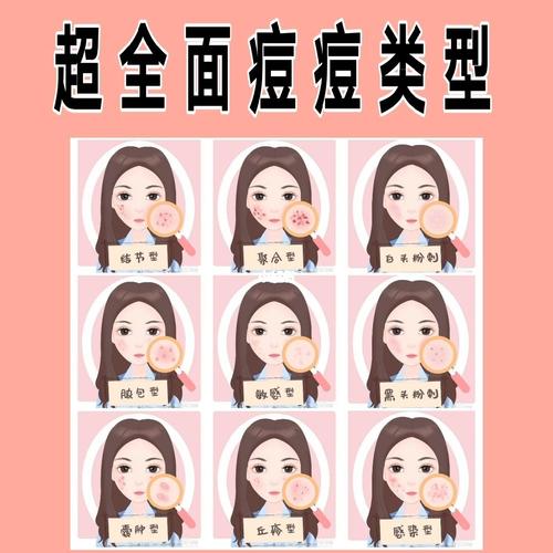 快来看看你是什么痘痘类型_痤疮_黑头粉刺_痘痘_豌豆