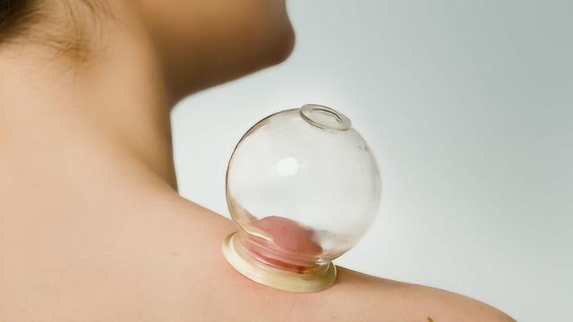 拔火罐时,后背出现的瘀血,是排出的毒素吗?或许和你想