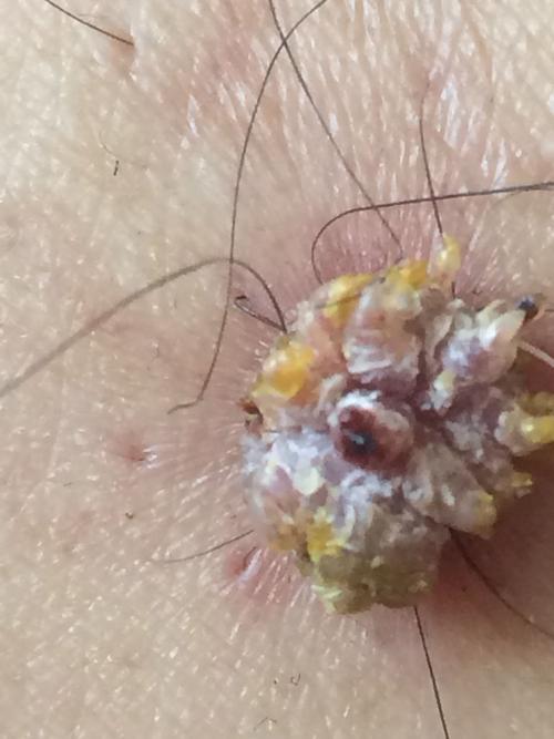 我小腿两个月前突然长出一个菜花状肉瘤,不痛不痒,就是感觉别扭,老师