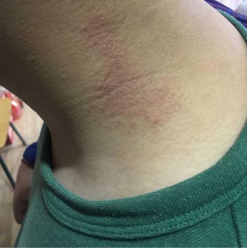 神经性皮炎发生的原因是什么?