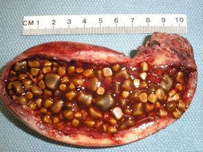 胆结石的检查根据种类不同而不同