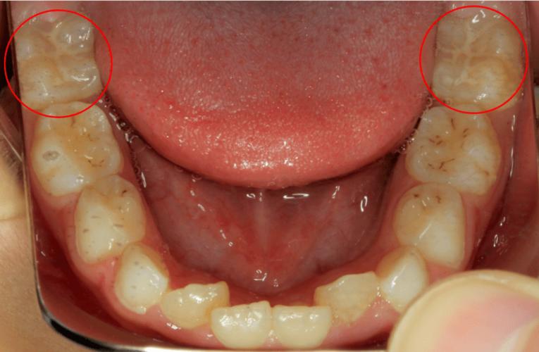口腔科普窝沟封闭保护小朋友的牙齿健康