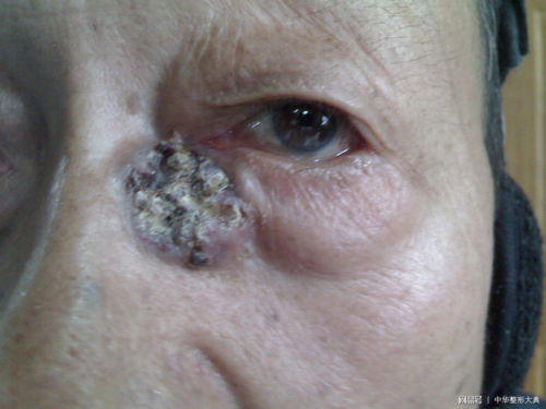 汪澍:鼻部及鼻周恶性肿瘤切除术后缺损的修复与重建策略