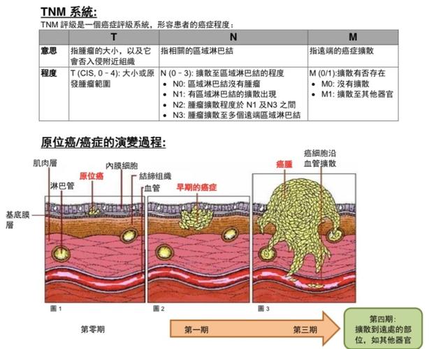原位癌是恶性细胞但未有穿透基底膜.