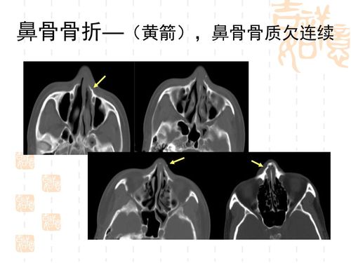67                扫描方法选择hrct 能客观显示外伤后异和鼻窦诸骨