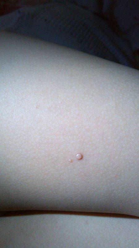 小孩身上有肉疙瘩