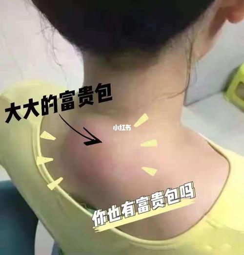 富贵包_针灸_中药_刮痧_按摩_医疗健康_医疗方法
