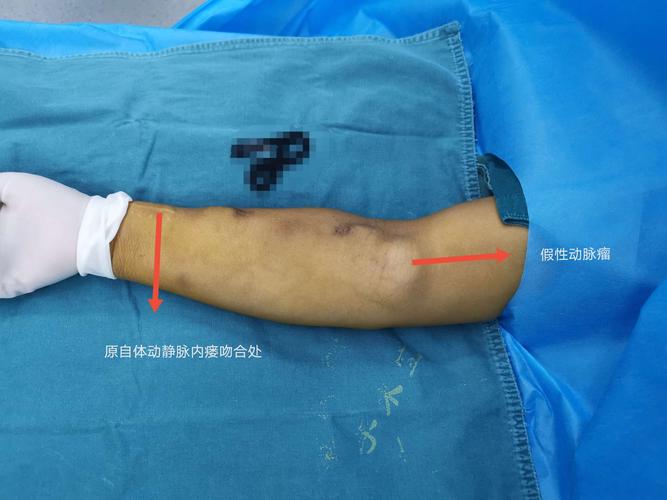 一例假性动脉瘤合并自体内瘘回流障碍个性化手术