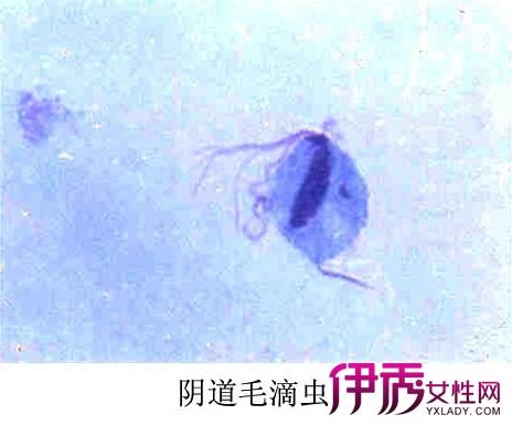 妇科疾病中,滴虫性阴道炎是不常见的一种妇科病,女性在月经期,妊娠期