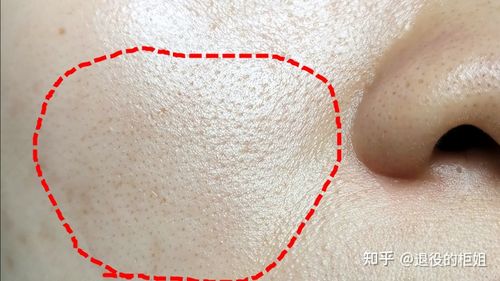 脸上黑头粉刺多,油性皮肤,毛孔粗大,有什么好的解决办法么?