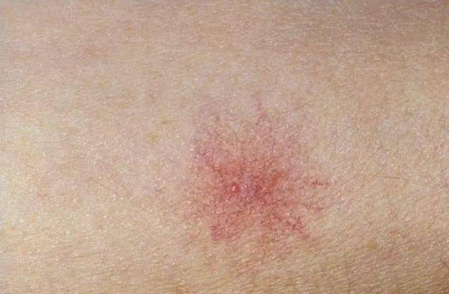 例如:病毒,细菌以及一些真菌方面的感染都有可能会出现红点这种症状