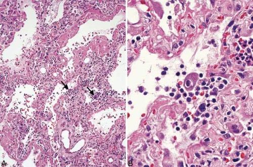 从病理学角度认识并了解病毒性肺炎