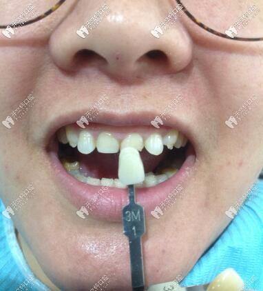 门牙磕断了必须根管治疗吗?她还做了瓷贴面呢,超赞