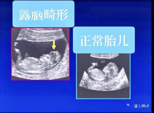 增加早孕超声诊断胎儿颅脑畸形的信心