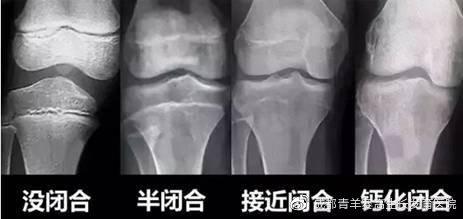 骨骺线闭合状态怎么看?