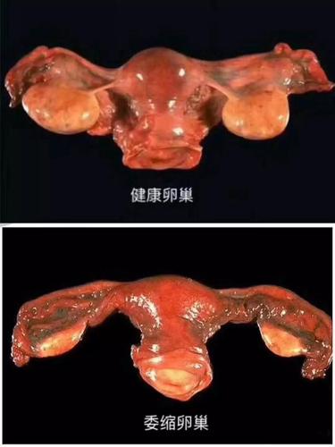 67卵巢早衰分三级你在哪一级