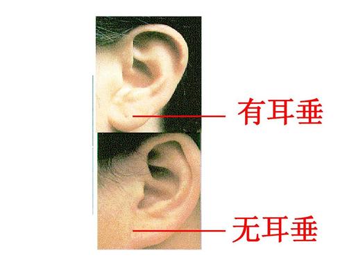 有耳垂 无耳垂