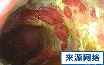 克罗恩病需要做哪些检查?