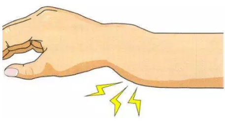 骨科知识 | 手腕骨折了该怎么办?