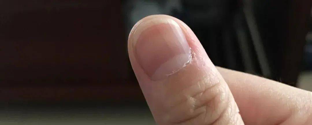 指甲长这样,不是大病就是癌!月牙,白点,竖线,代表着什么