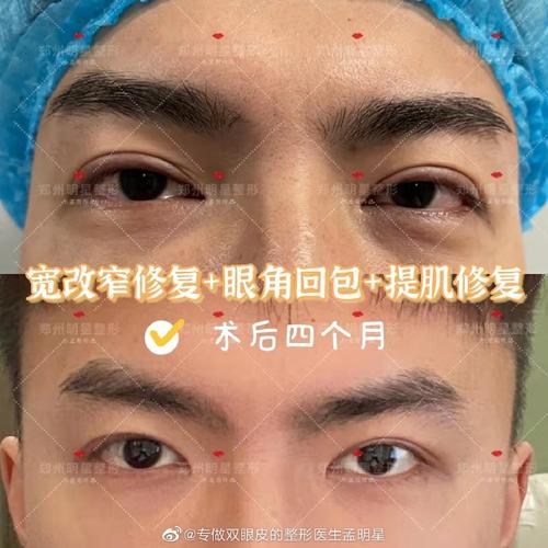 医美整形与健康超话男生双眼皮宽度推荐!一个被双眼皮修复拯救的男生!