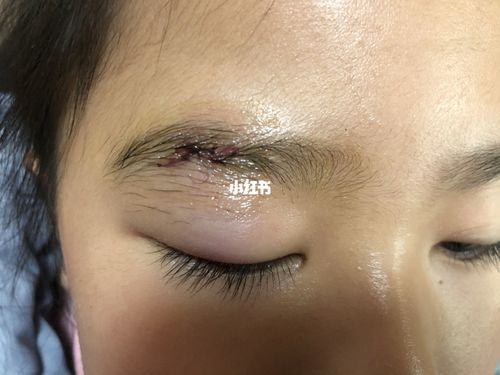 孩子眉骨那磕伤了缝了针_疤痕_医院美容_眼科_茶几_母婴_育儿经验