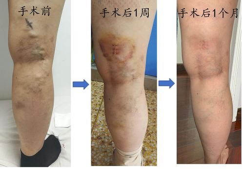 下肢静脉曲张超微创手术一一一一chiva手术