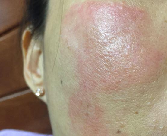 脸部接触性皮炎,认清症状正确护理