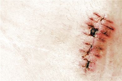 恢复_疤痕_图片大全—全景创意图库(quanjing.com)的