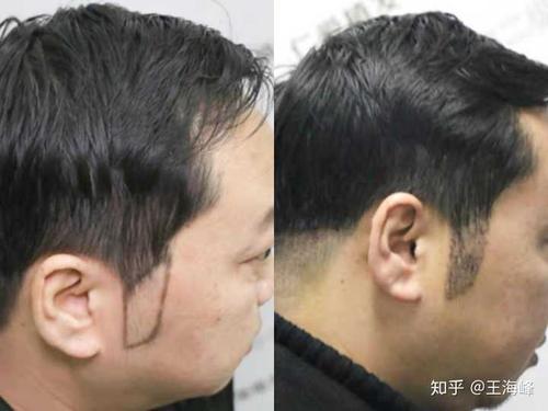 鬓角植发和秃顶植发的原理一样,都是取后枕部头发,不知道你想了解哪些