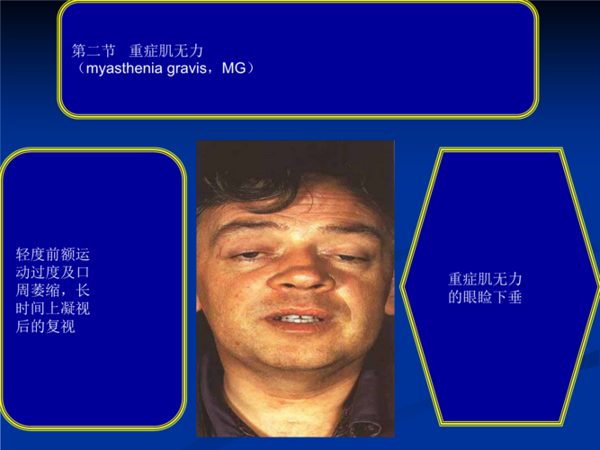 常见疾病病因和治疗方法——重症肌无力.ppt