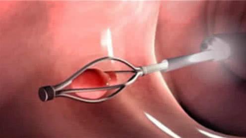 男性结扎手术对身体有影响吗?3d模拟全过程,很多人都想错了