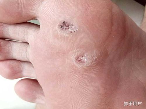 跖疣的自愈性大吗