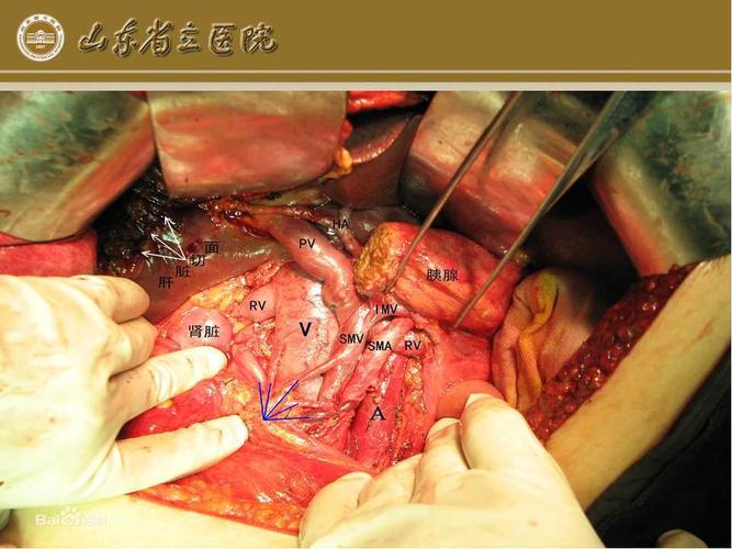 胰十二指肠切除术手术须知